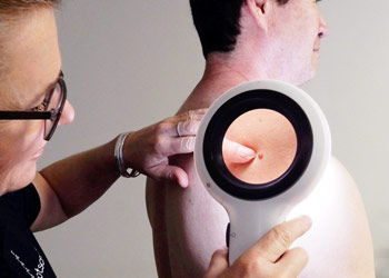 Inteligența artificială ar putea detecta cancerul de piele