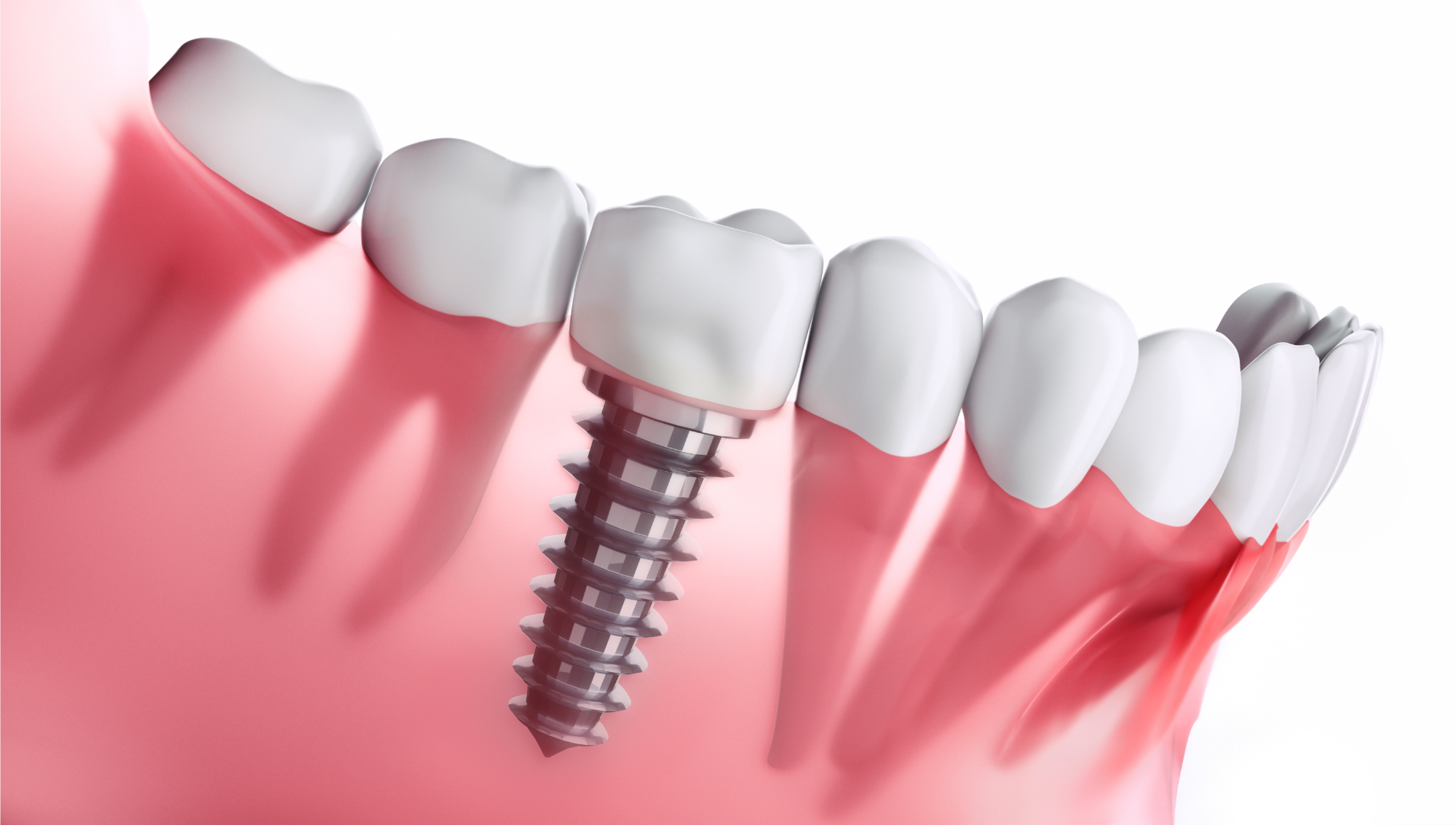 Implantul dentar – o soluție modernă pentru sănătatea orală